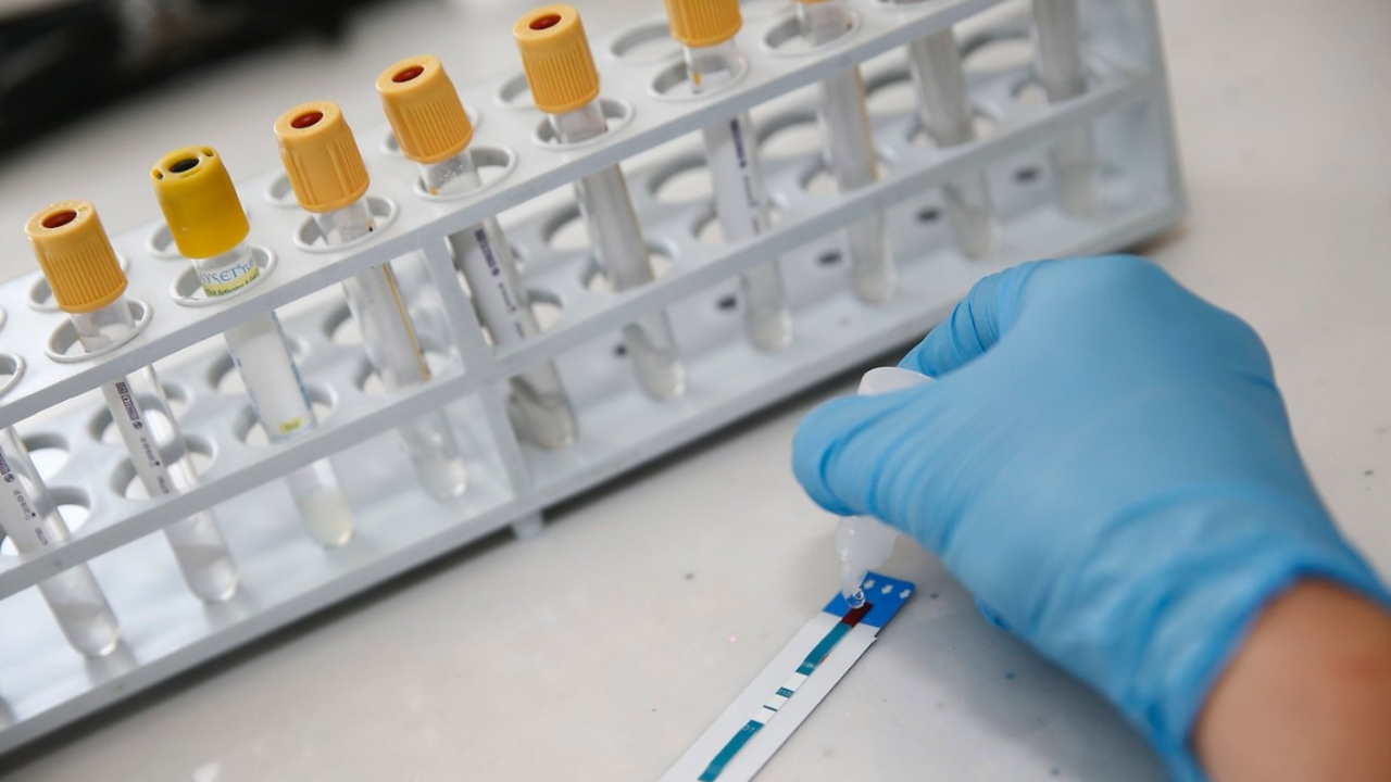 Türkiye'de 26 bin kişi HIV pozitif