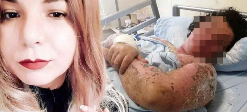 Yanlış antibiyotik kullanımı hayatını zindana çevirdi!