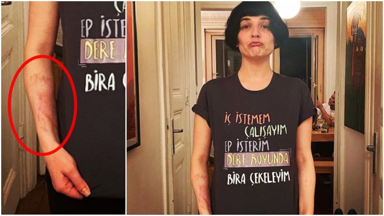 Gonca Vuslateri kaynar suyla haşlandı