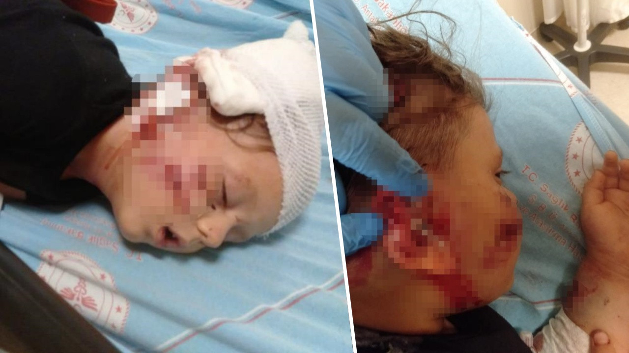 Sevmek istediği köpek 3,5 yaşındaki çocuğu bu hale getirdi: 50 dikiş atıldı...