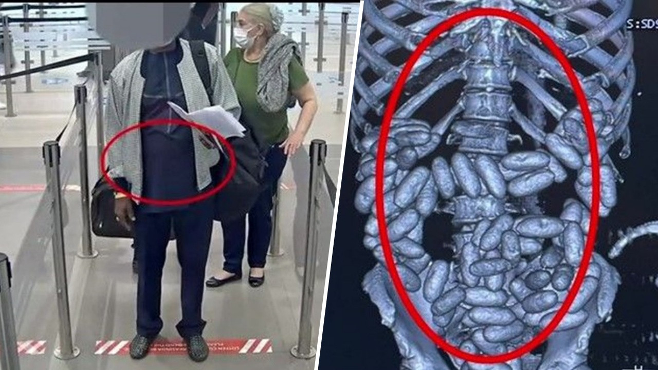 İstanbul Havalimanı'nda inanılmaz olay! Yolcunun midesinden çıkanlar şoke etti!