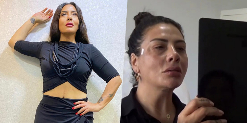 Estetik yaptıran ünlüler kervanına Işın Karaca da katıldı! İşte operasyon sonrası ilk görüntüsü