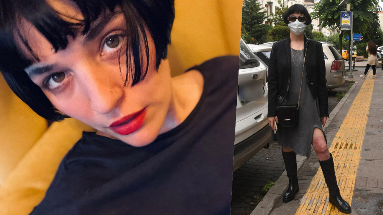 Üzerine kaynar su dökülmüştü! Gonca Vuslateri yanan bacağının son halini gösterdi