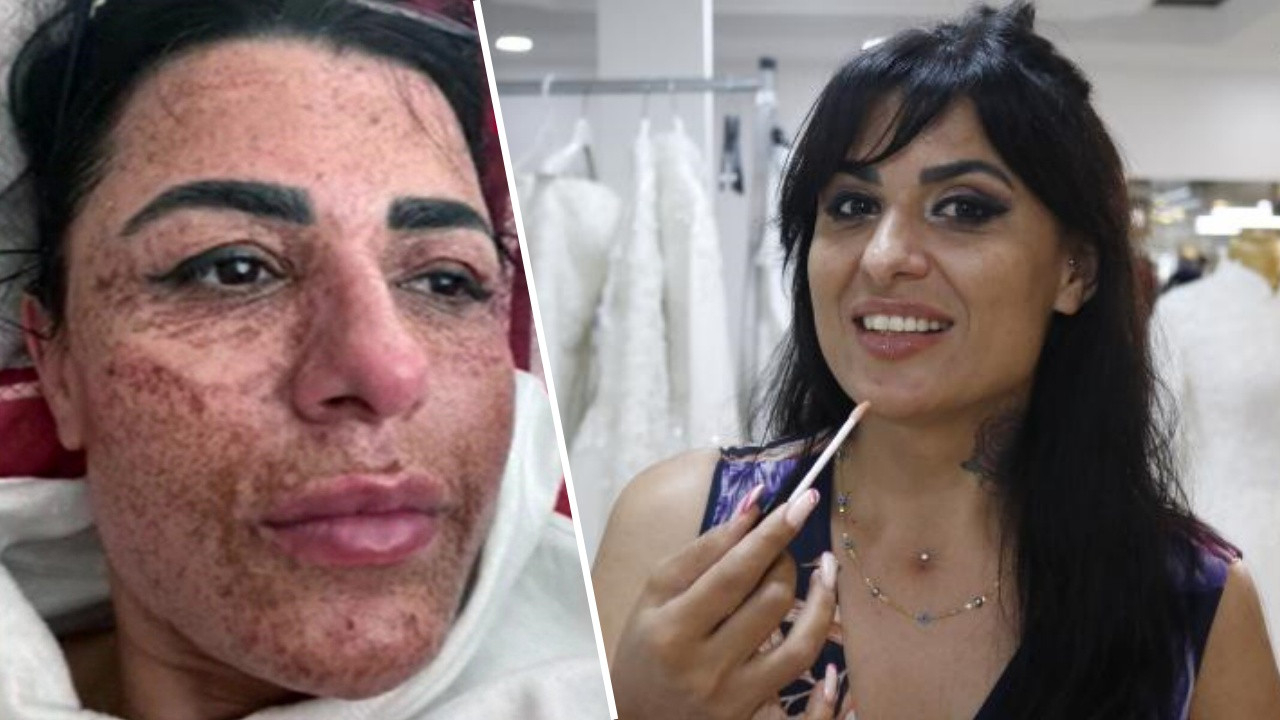 Güzelleşmek uğruna kabusu yaşamıştı! Yüzü tamamen yanan kadından sevindiren haber