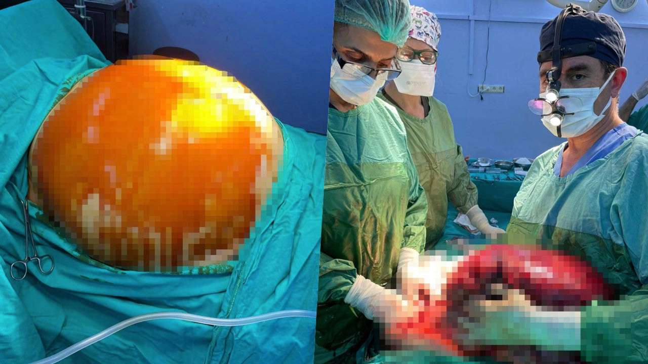 Safra kesesi şikayetiyle doktora gitti, ameliyattan 16 kilo vererek çıktı!