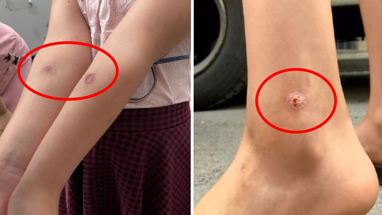 İstanbul'da korkutan alarm: Özellikle çocukların vücudunda çıkıyor!