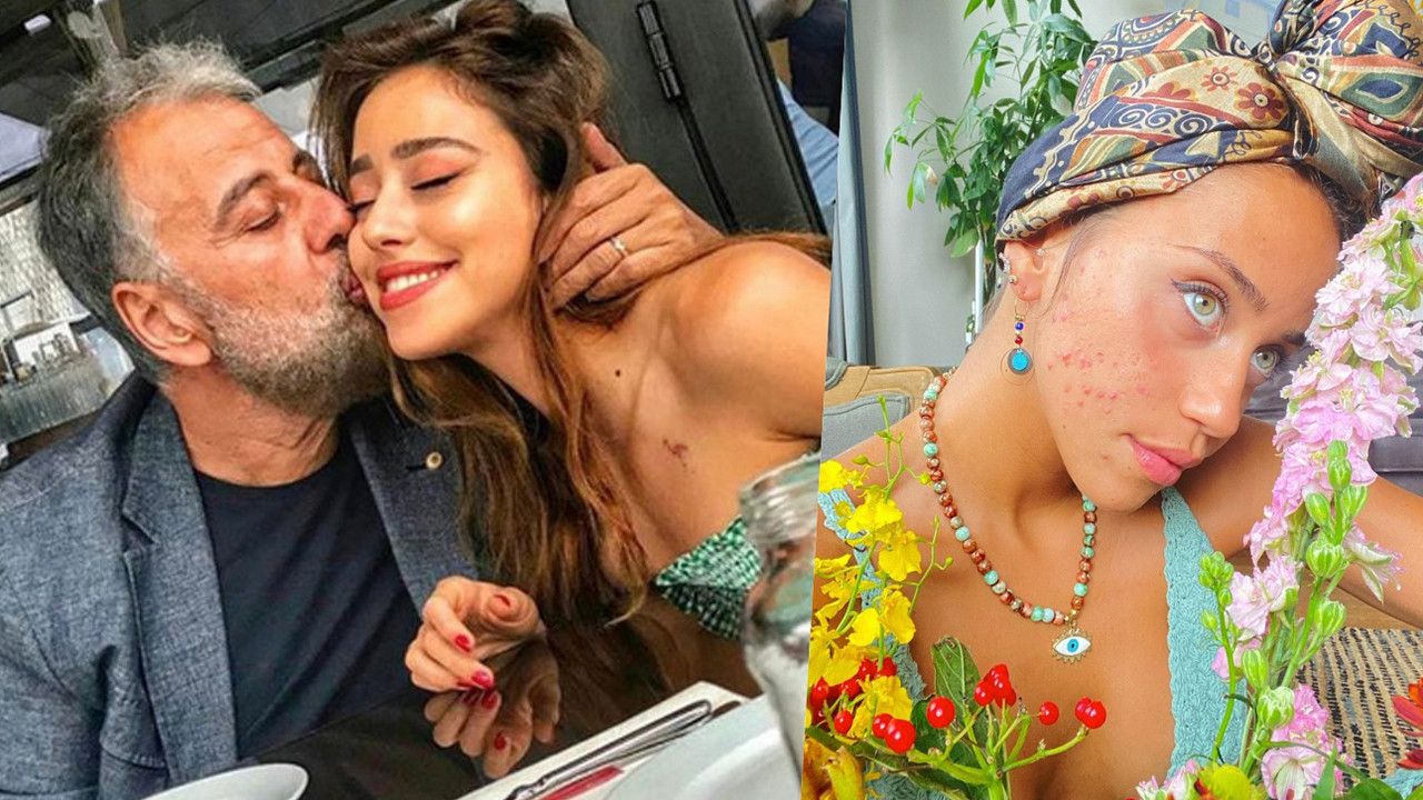 Yüzünde sivilceler çıkan Zeynep Alkan son halini paylaştı