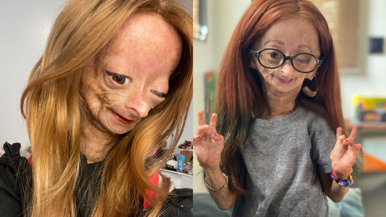 Erken yaşlanan ünlü Youtuber'dan acı haber! Adalia Rose Williams 15 yaşında hayatını kaybetti