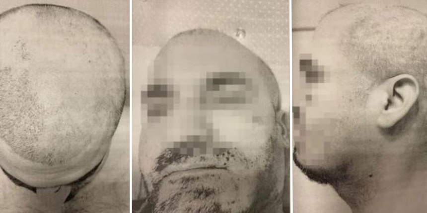 Öğrenci yurdunda akılalmaz işkence: Sıcak ağdayla sakallarını ve saçlarını kökünden kopardılar!