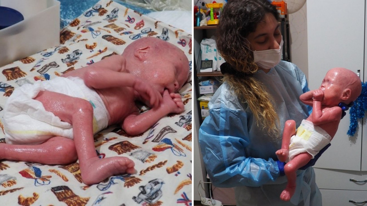 Türkiye'nin yılan bebeği Gökdeniz 1 yaşında: Annesi ilk kez öpebildi!