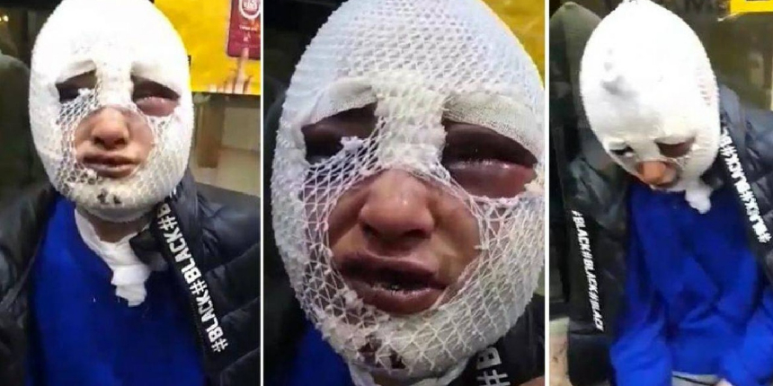 Kız arkadaşının yüzüne kızgın yağ döken zanlıya yeniden yakalama kararı