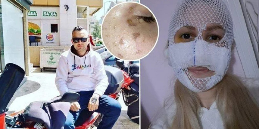 Eski sevgilisinin yüzüne kimyasal madde atan sanık tutuklandı!