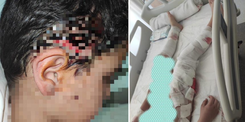 Okula giden 10 yaşındaki çocuğa başıboş 8 sokak köpeği saldırdı: 10 saniye geciksek ölebilirdi!
