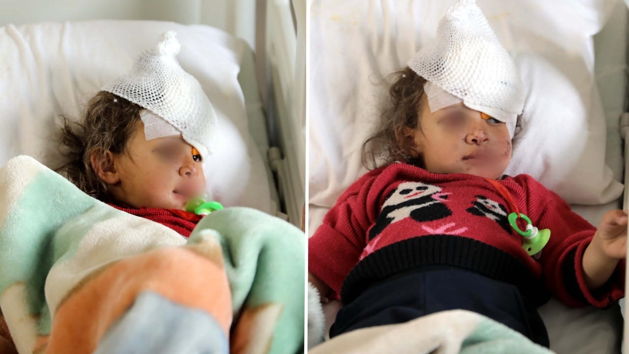3 yaşındaki Fatma'nın yüzünü eşek ısırdı: Boyun derisinden göz kapağı yapıldı!