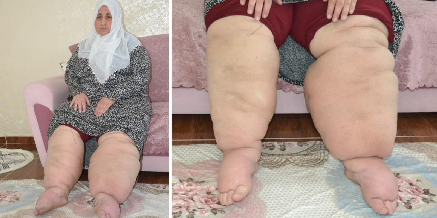 15 yıldır hastalığına teşhis konulmayan kadının hayatı kabusa döndü