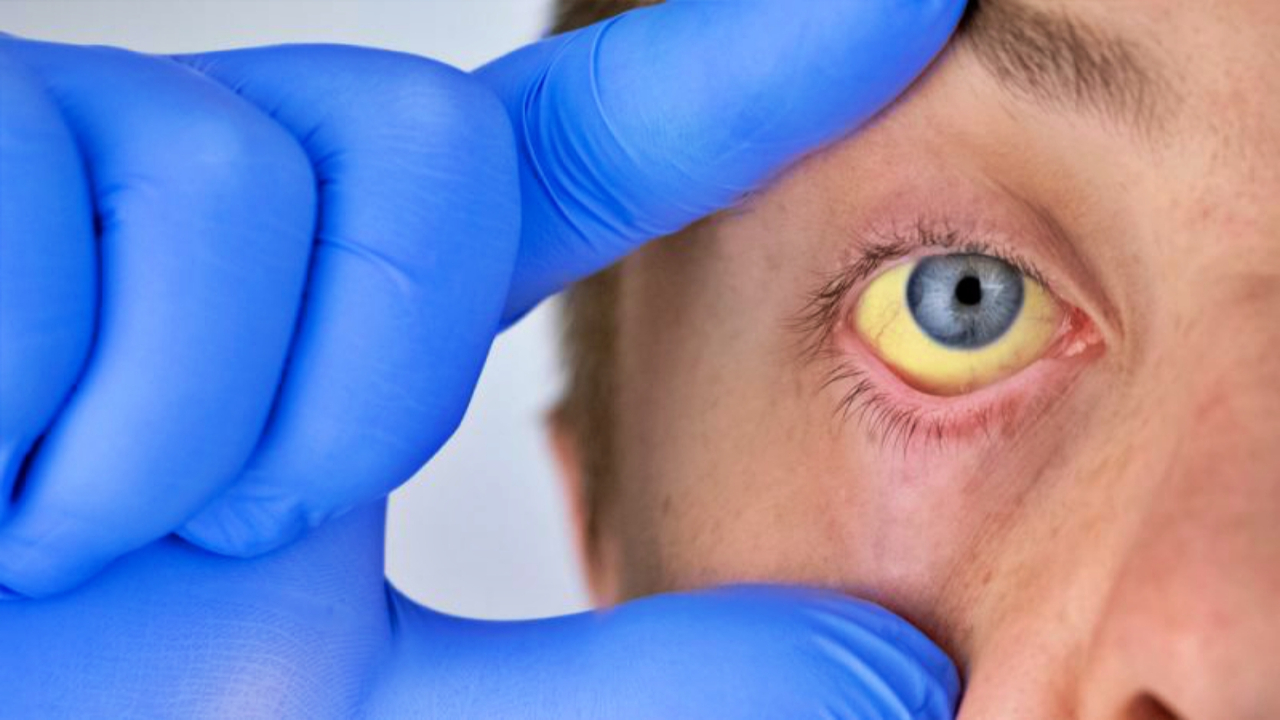 Şimdi de Meksika'da görüldü: Gizemli hepatit 20 ülkeye yayıldı!