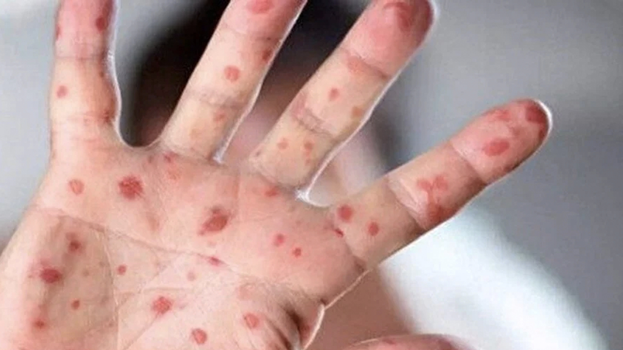 Maymun çiçeği virüsünde vakalar iki kat arttı: DSÖ 'Böylesi görülmedi' dedi