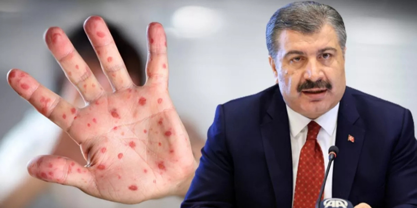 Bakan Koca duyurdu: Türkiye'de beş maymun çiçeği vakası tespit edildi!