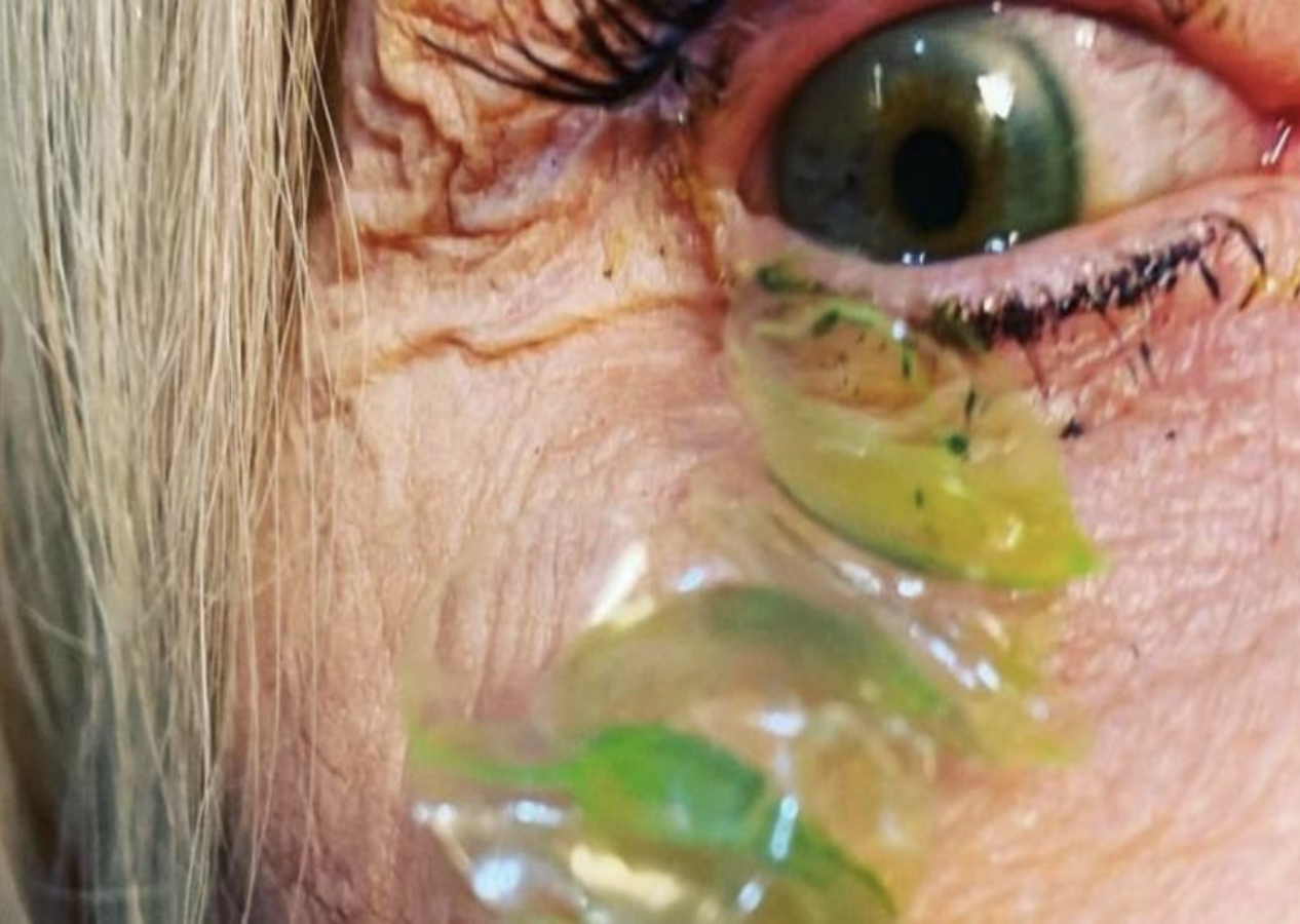 Gözünde 23 tane kontakt lens unutan hastanın videosu viral oldu