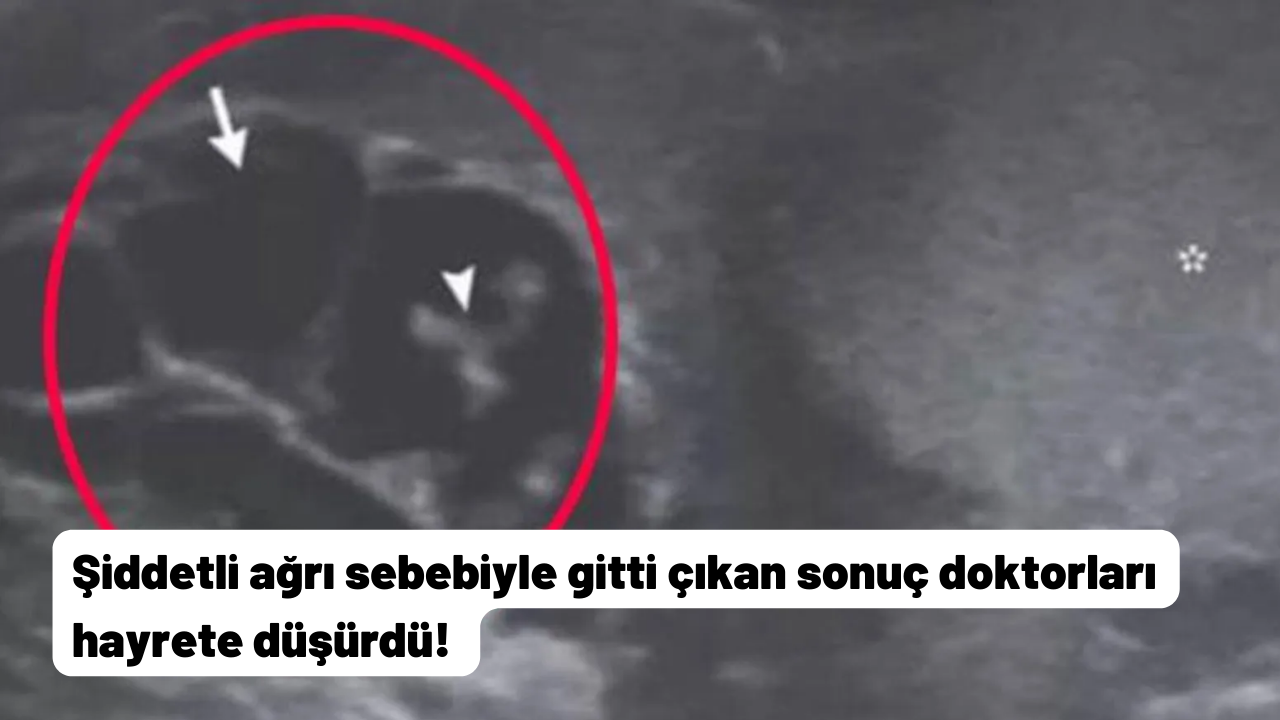 Şiddetli ağrı sebebiyle gitti çıkan sonuç doktorları hayrete düşürdü!