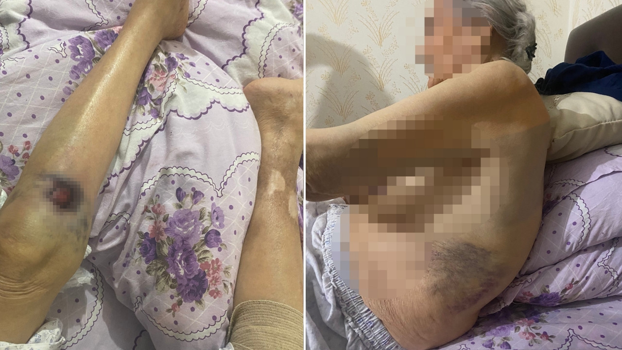 Ankara'da bakıcı dehşeti! Yaşlı kadının başından aşağı sıcak yemek döktü!