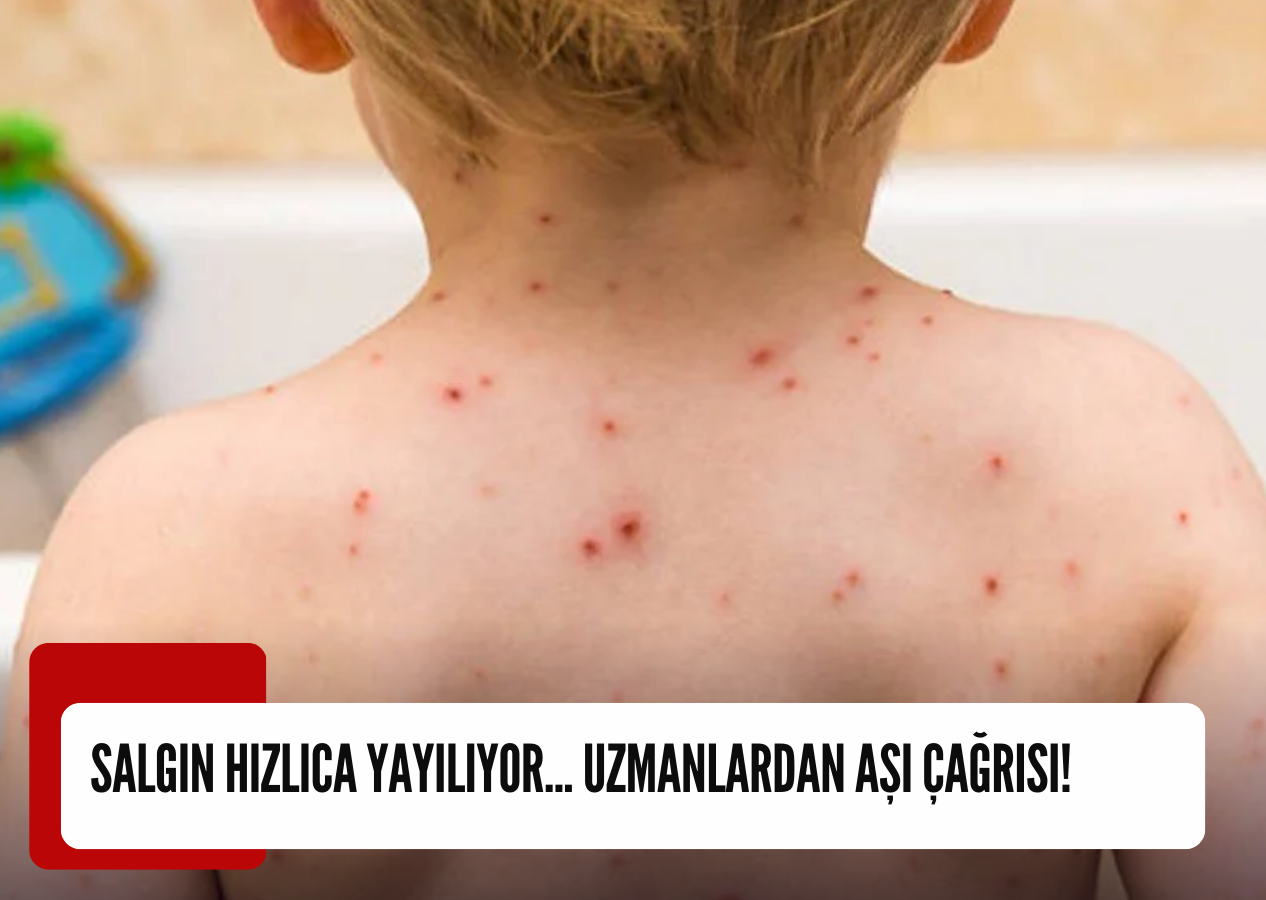 Salgın hızlıca yayılıyor... Uzmanlardan aşı çağrısı!