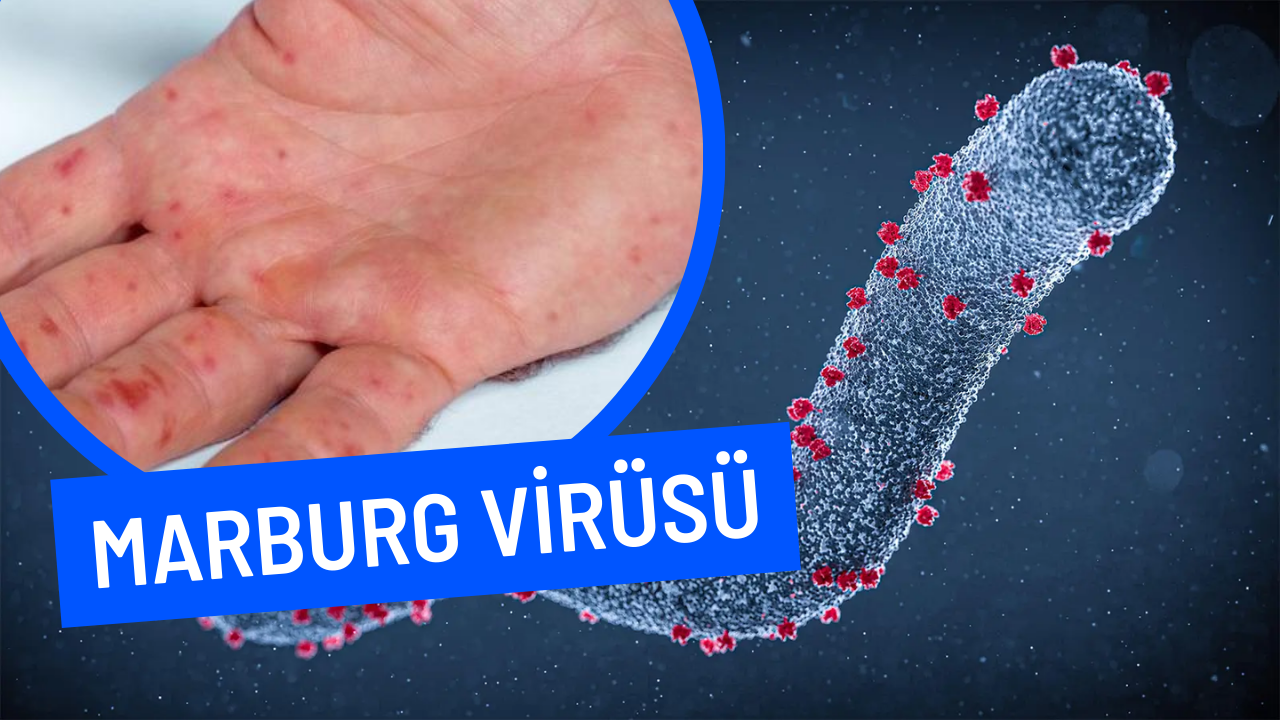 Böylesi ilk defa görüldü! Bu ölümcül virüsün tedavisi ve aşısı yok! Marburg virüsünden 5 kişi hayatını kaybetti