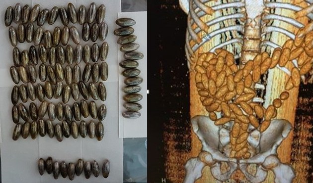 Midesinden 102 kapsül uyuşturucu çıktı...