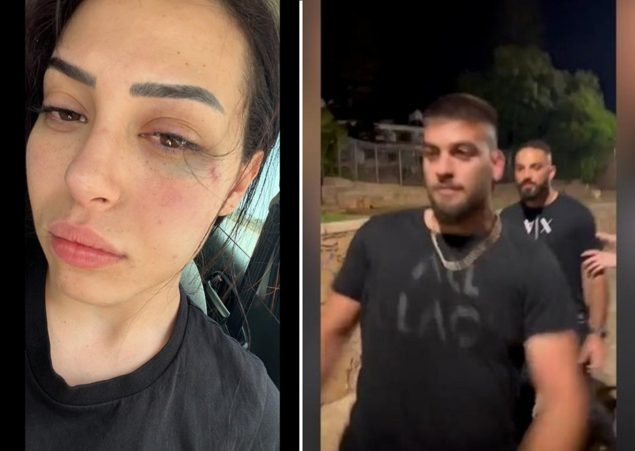 Kıbrıs Türkü Asya Karaali’ye 3 Rum erkekten ırkçı saldırı! Parmaklarını kırıp duvardan attılar