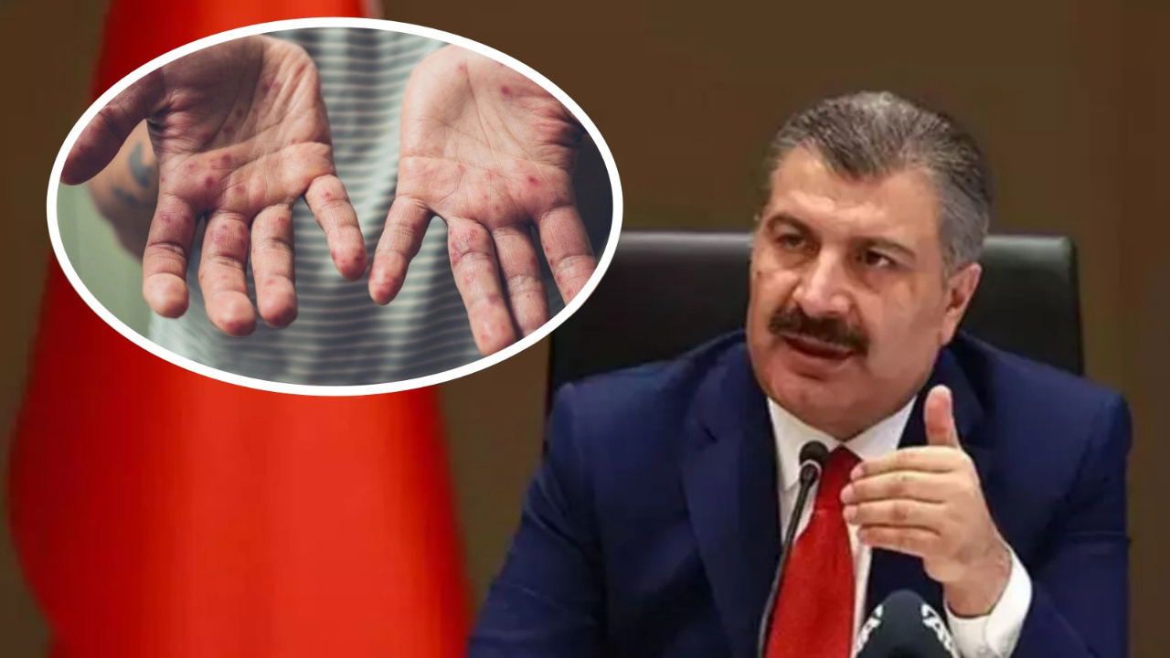 Kaygı uyandıran 'kızamığa bağlı ölüm' iddiaları... Bakan Koca'dan son dakika açıklaması!