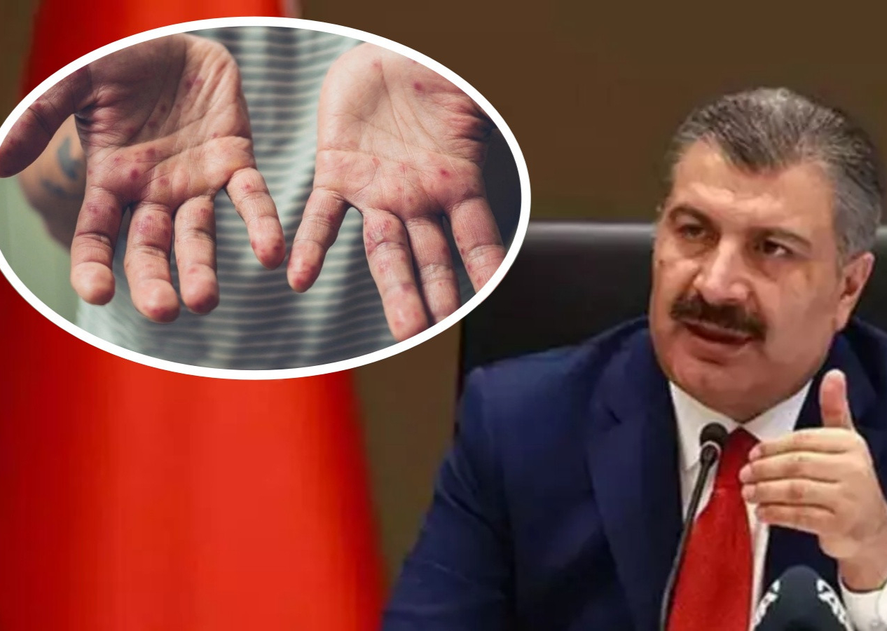 Kaygı uyandıran 'kızamığa bağlı ölüm' iddiaları... Bakan Koca'dan son dakika açıklaması!