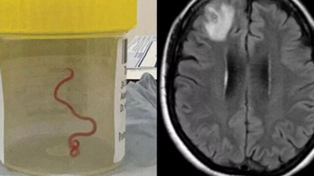 Ameliyata giren kadının beyninden çıkan 8 cm'lik cisim doktorları şoke etti! Daha önce görülmemiş bir vaka...