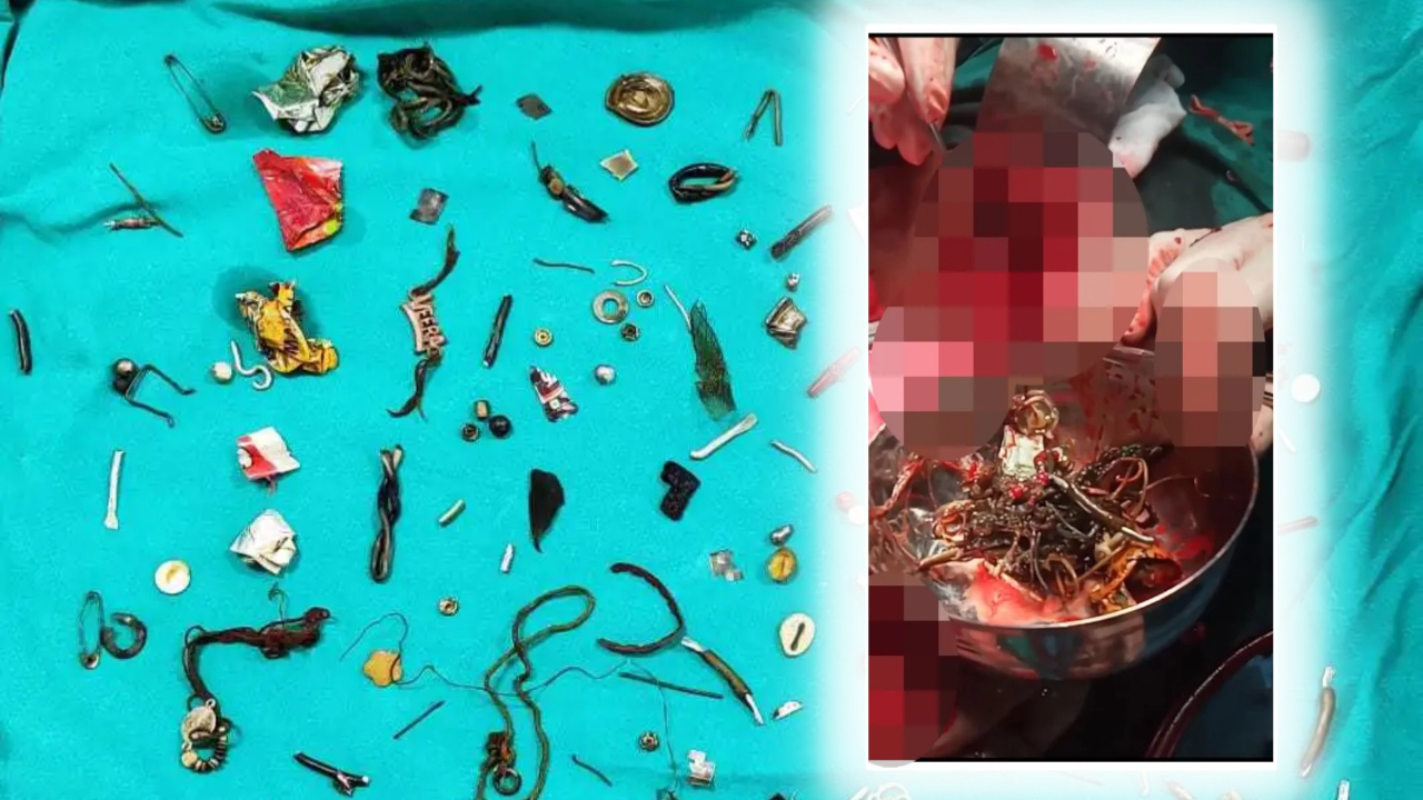 Mide ağrısıyla hastaneye gitti: Bağırsaklarından 60 ev eşyası çıktı