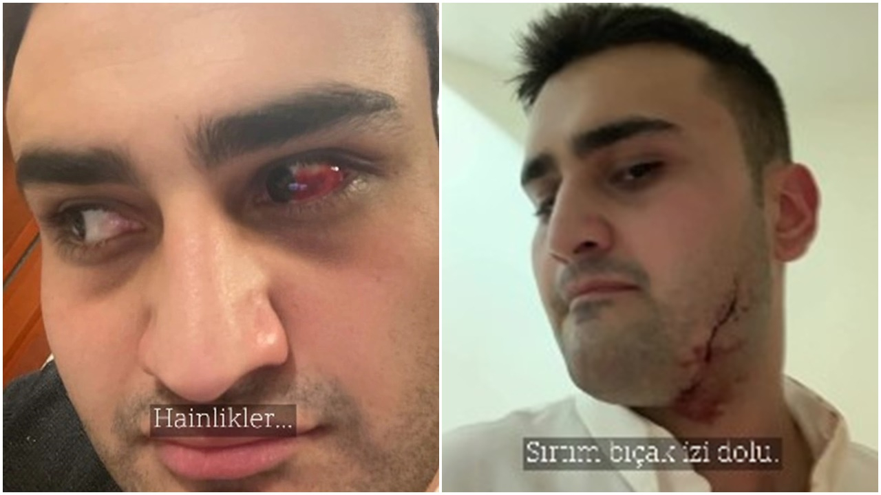 CZN Burak yüzü, gözü yara içindeki paylaşımıyla herkesi korkutmuştu! Ünlü şef o fotoğraflarla ilgili konuştu