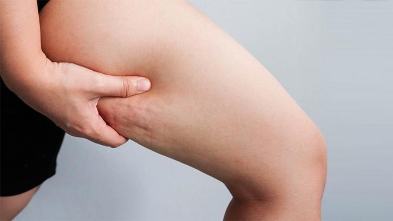Lipoliz nedir? Ne işe yarar? Lipoliz zayıflatır mı?
