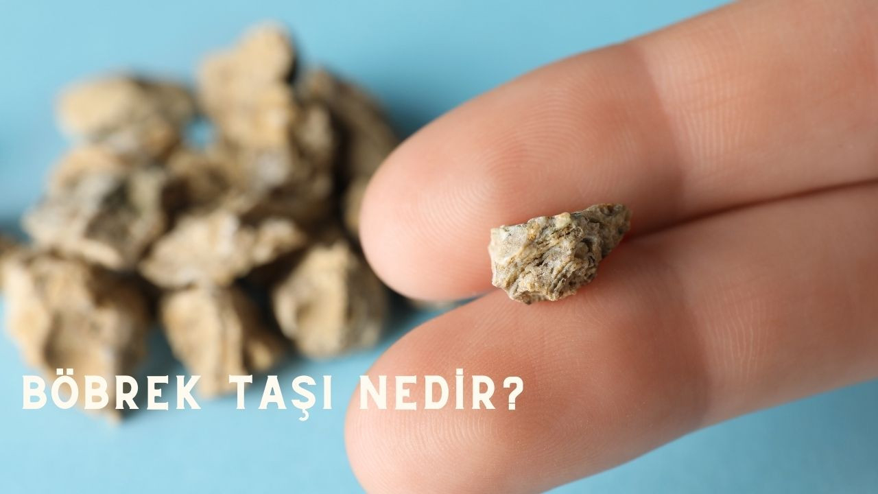 Böbrek taşı oluşumu, böbrek taşı tedavisi, böbrek taşı düşüren kürler