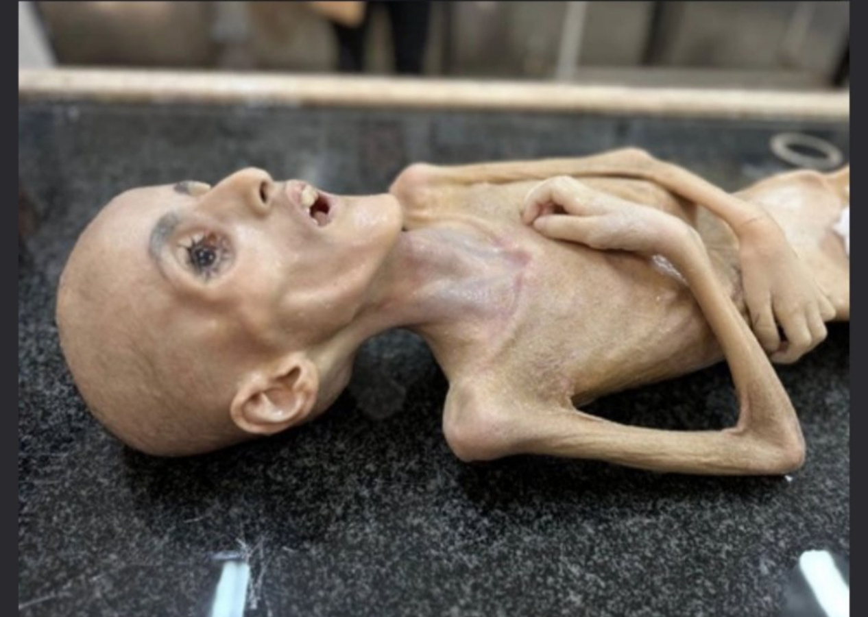 Gazze'de trajedinin fotoğrafı... Filistinli Yezen el-Kefarne yetersiz beslenme nedeniyle hayatını kaybetti