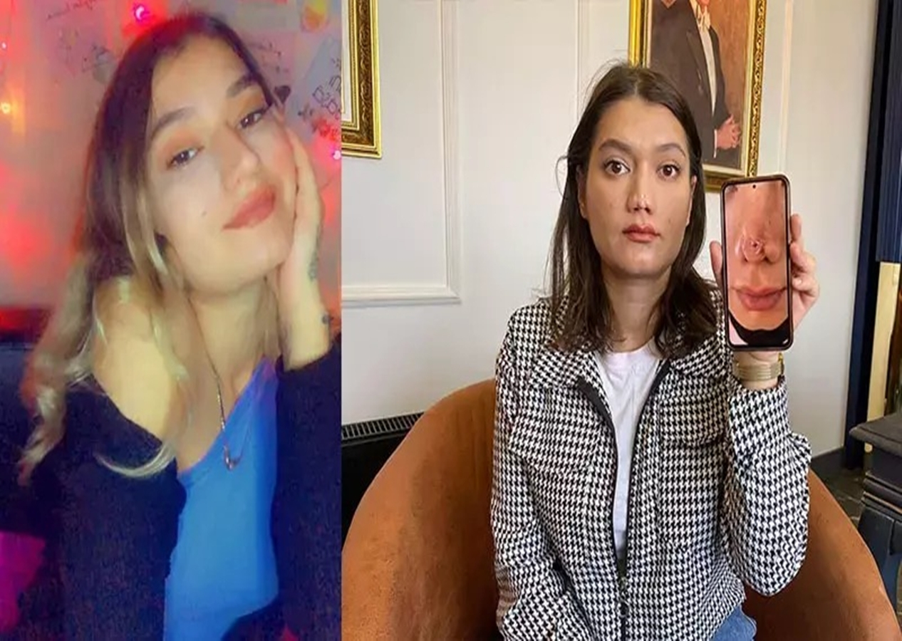 Ameliyatta burun estetiği bozuldu! 1 milyon liralık tazminat davası açtı