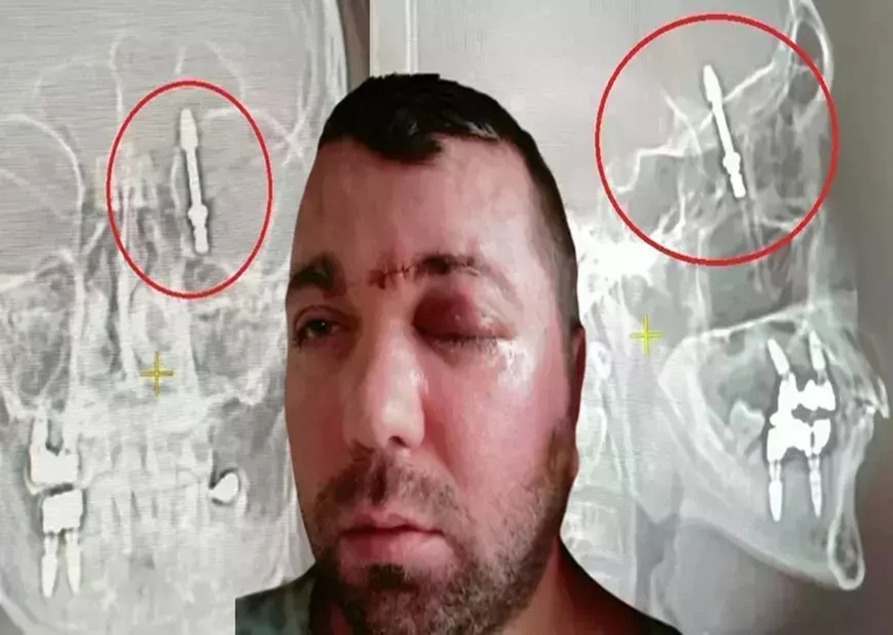 Bursa’da diş ameliyatında vahşet! Beynine vida saplandı