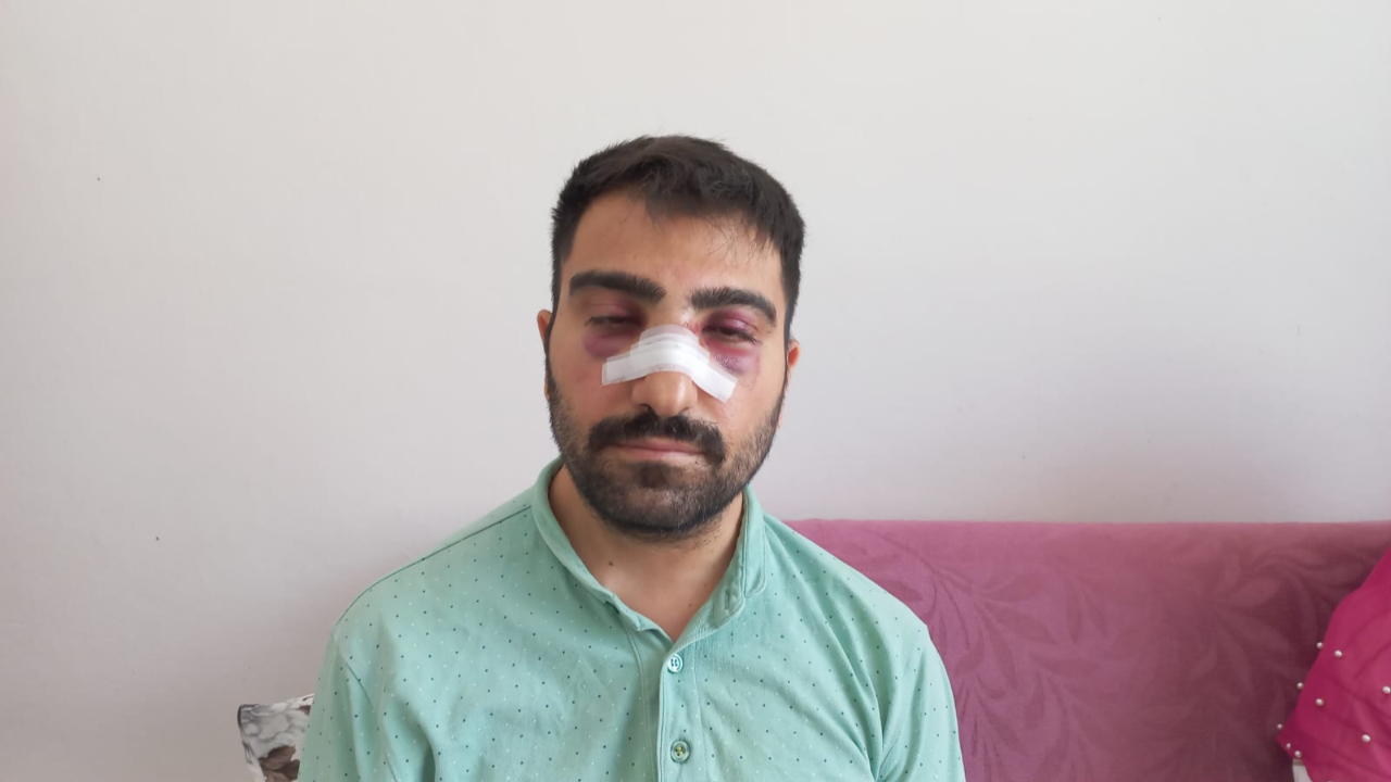 Engelli komşusunun burnunu kırdı ardından sıcak su döktü