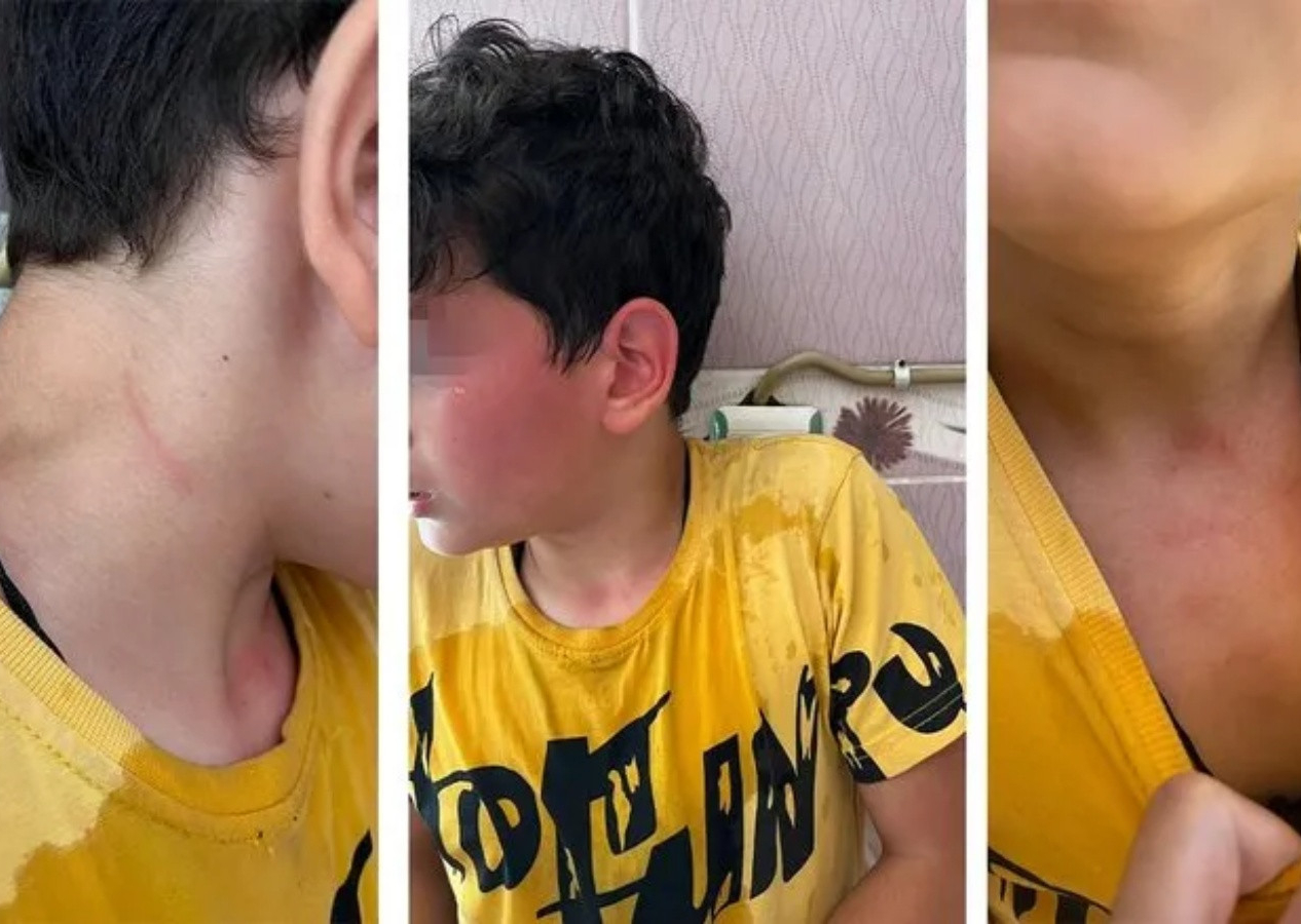 Karaman'da öğretmen dehşeti! Öğrencisini kaynar suyla haşlayıp başını duvara vurdu!