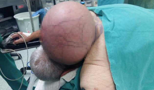 Doktorlar bile şok oldu! 50 yıldır ensesinde taşıyordu...