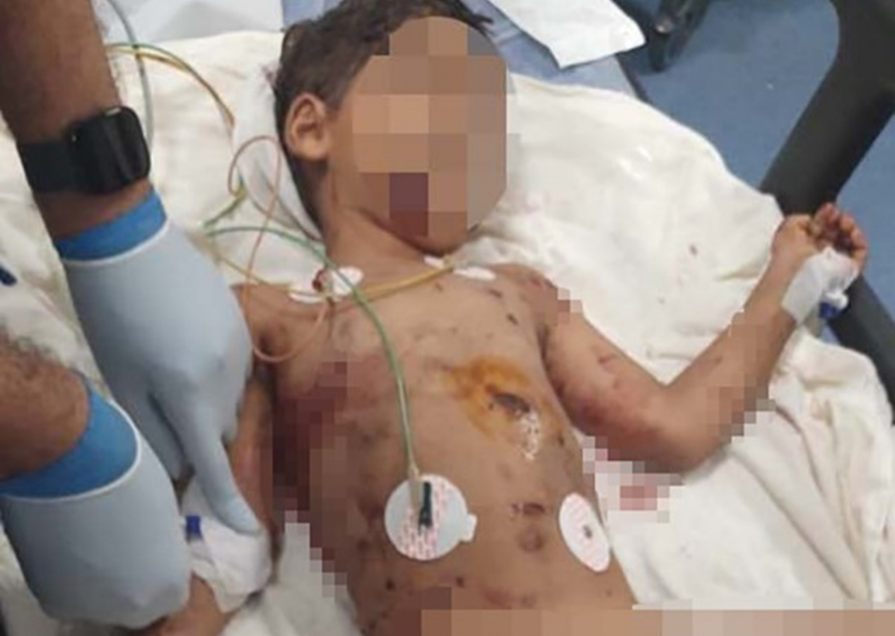 Adana'da 5 köpeğin saldırısına uğrayan minik Abbas hastanede yaşam mücadelesi veriyor
