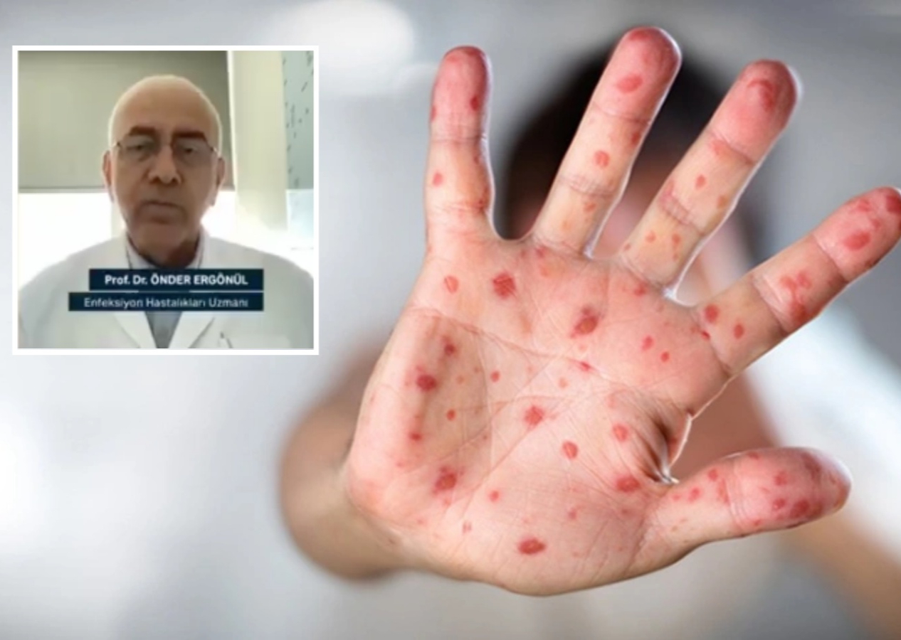 Prof. Dr. Önder Ergönül'den ürküten açıklama: Türkiye’de bazı hastanelerde tek tük Maymun Çiçeği vakası var!