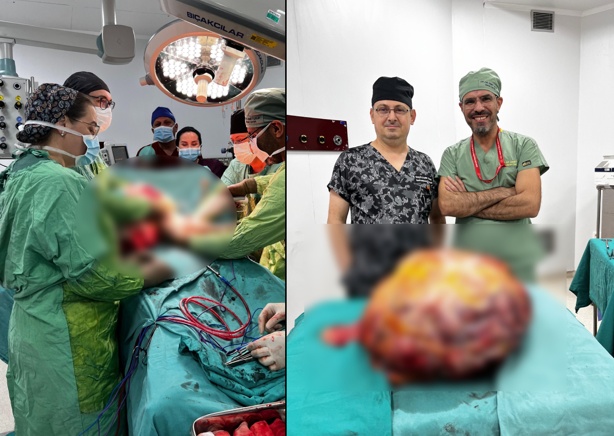 Karnım ağrıyor diye gittiği hastanede karnından 26 kiloluk tümör çıkarılan hasta doktorları bile şaşırttı