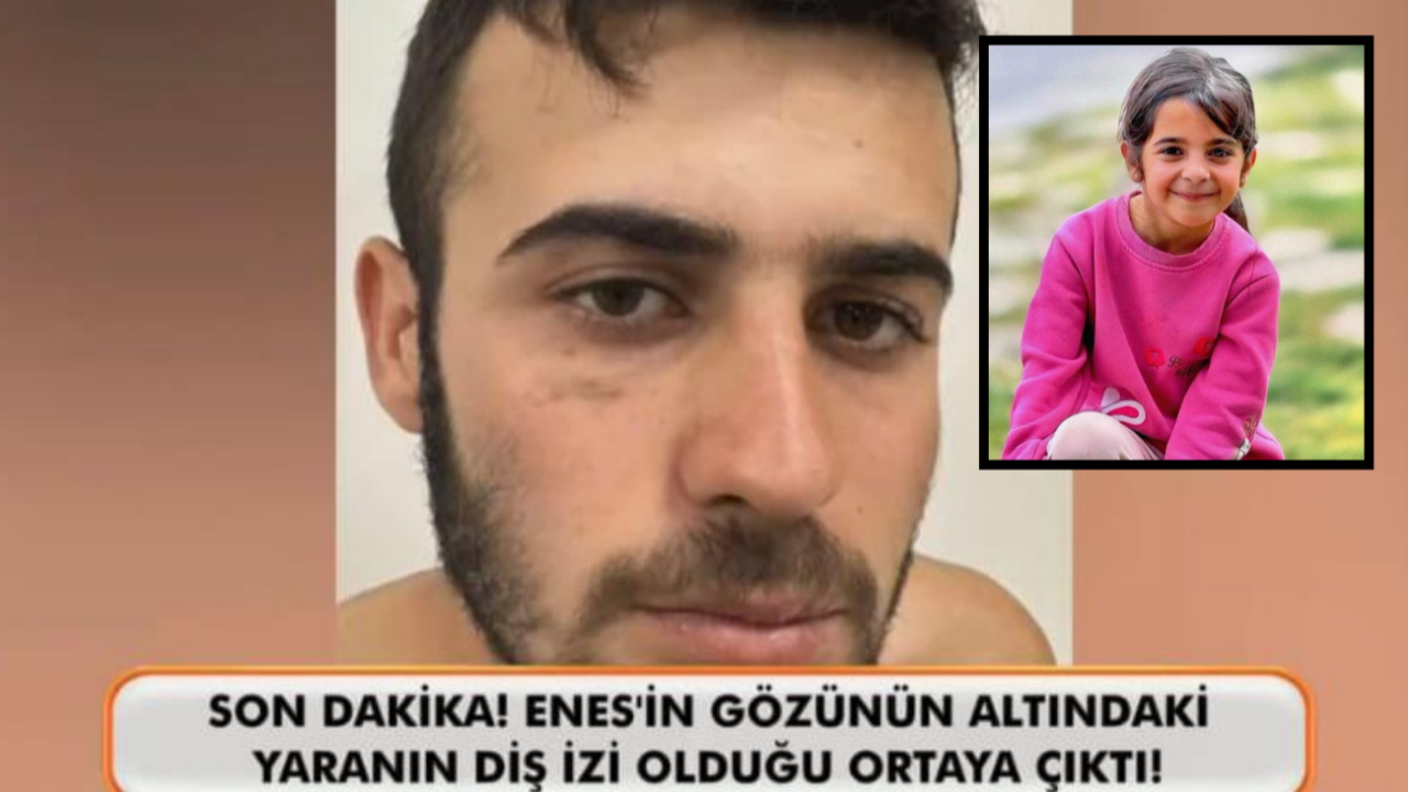 Narin Güran cinayetinde flaş gelişme! Enes Güran'ın gözünün altındaki yara izinin diş izi olduğu ortaya çıktı