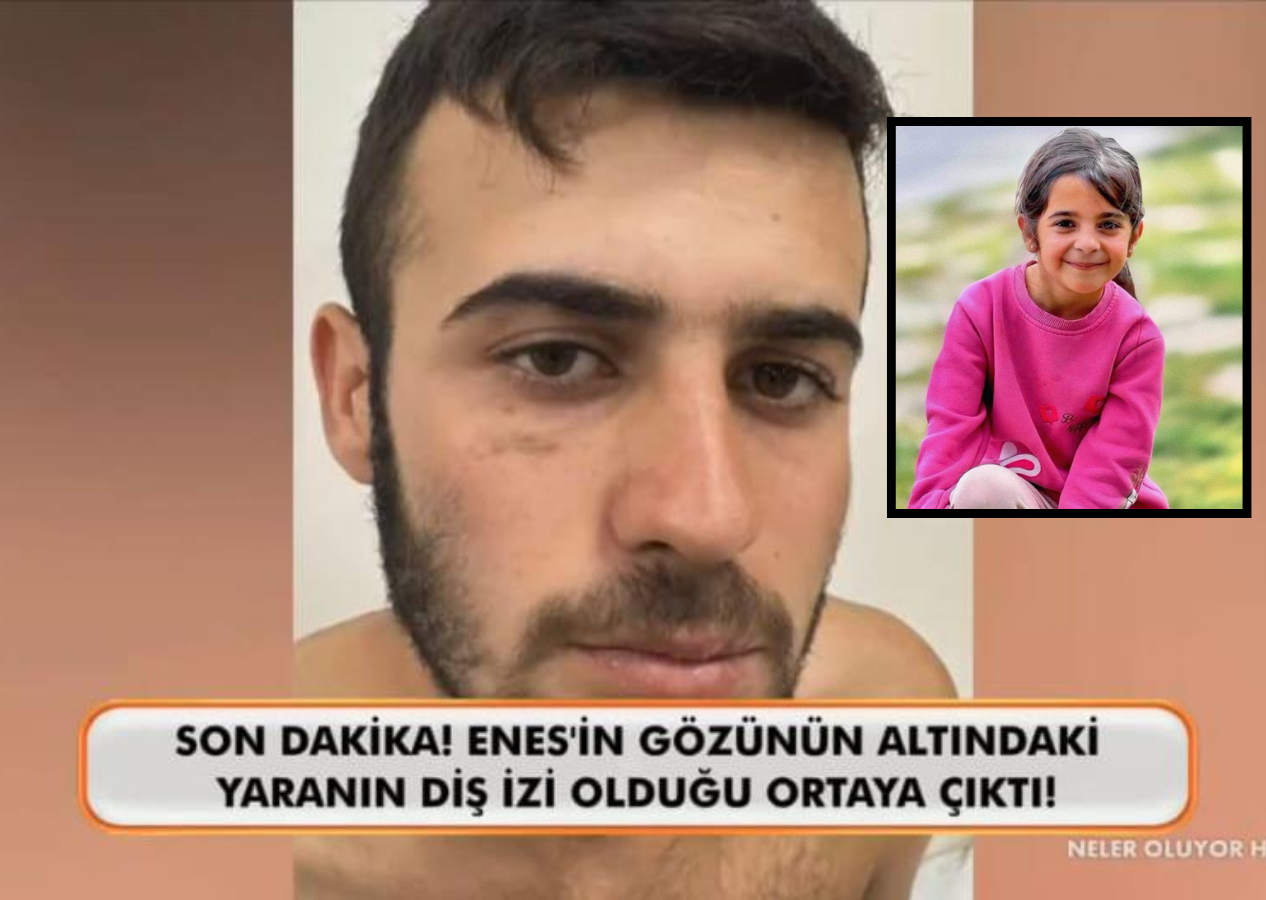Narin Güran cinayetinde flaş gelişme! Enes Güran'ın gözünün altındaki yara izinin diş izi olduğu ortaya çıktı