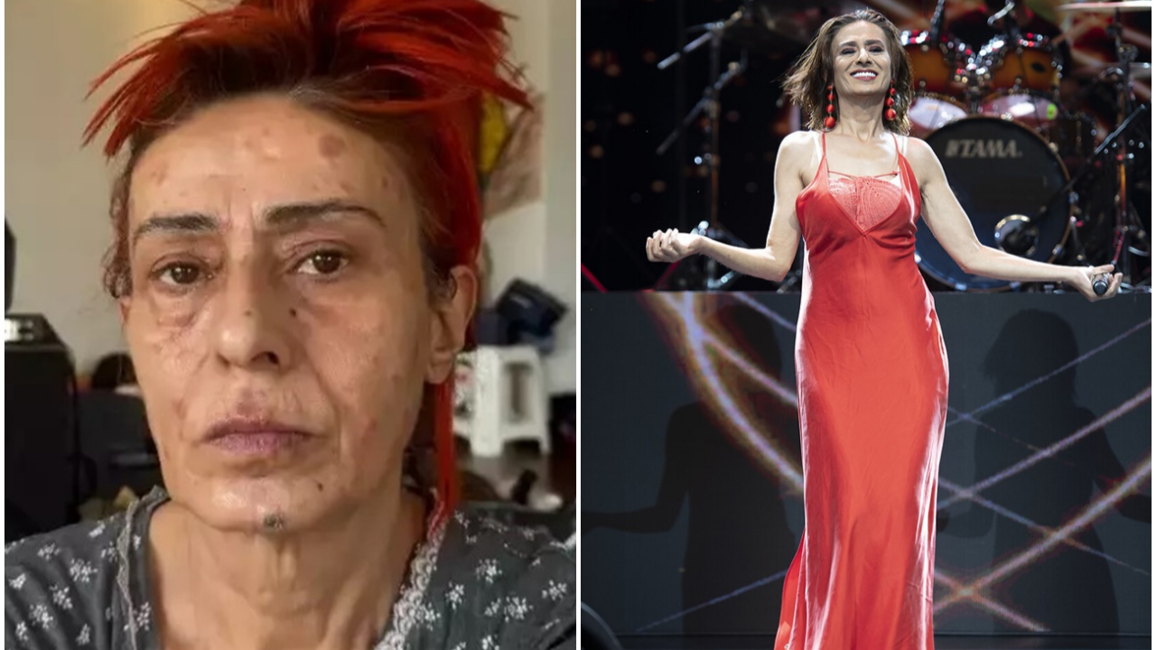 Yüzünde kimyasal yanıklar oluşmuştu! İşte Yıldız Tilbe'nin son hali