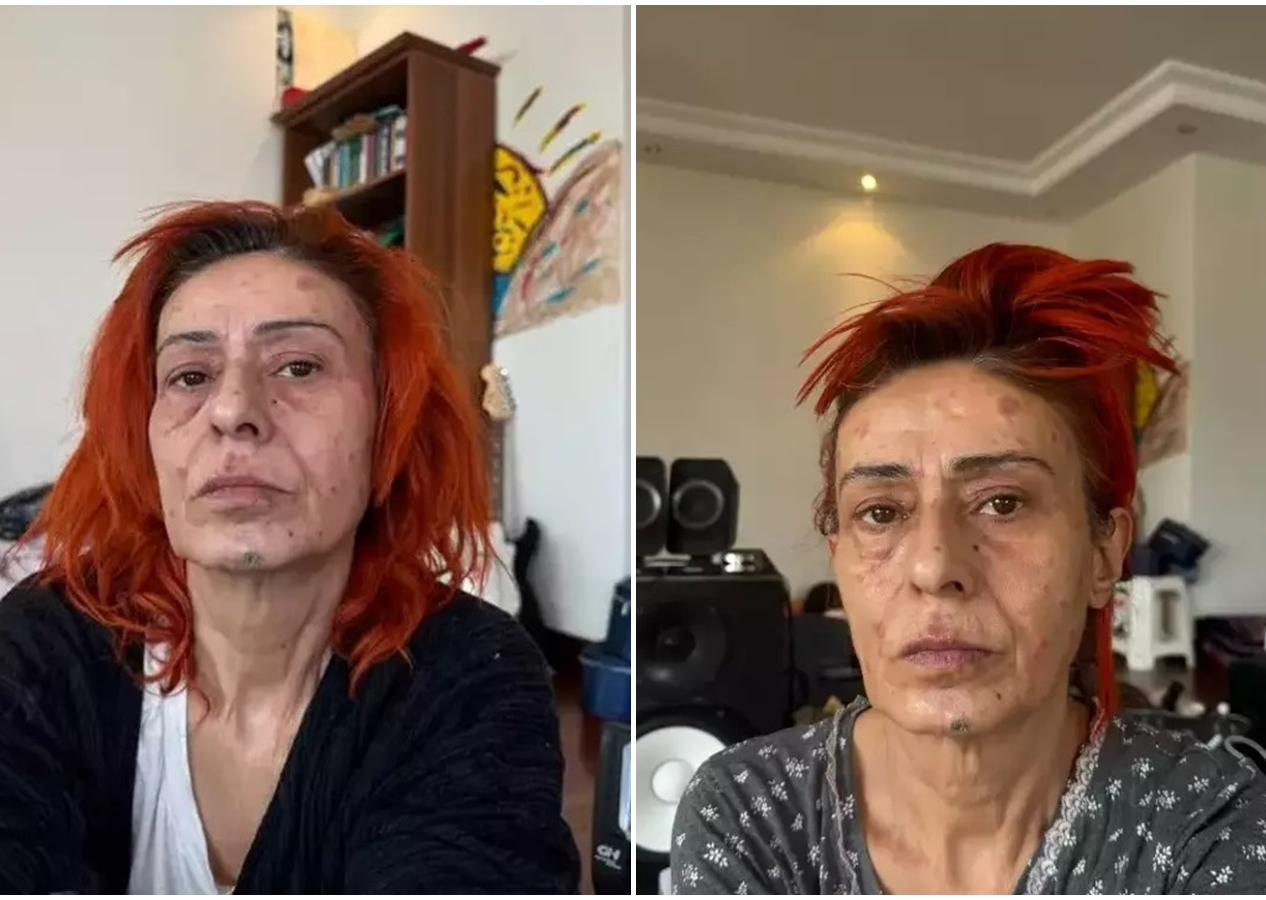 Saç boyası krizi! Yıldız Tilbe, ‘Uyuduğu için yüzü yandı’ iddialarına cevap verdi: Boya kötüymüş!