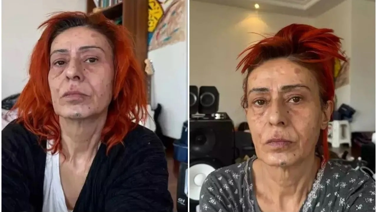 Saç boyası nedeniyle yüzünde kimyasal yanıklar oluşan Yıldız Tilbe çareyi maske takmakta buldu